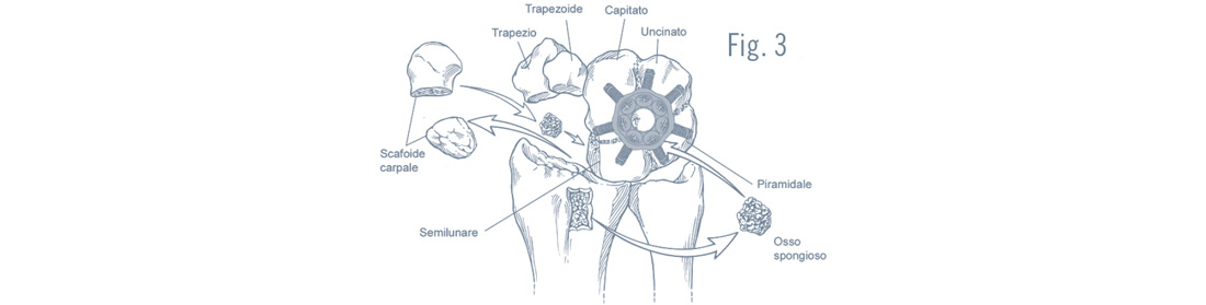Artrosi-del-polso-Parziale_2