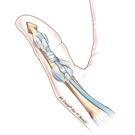 Poggiadito In Gomma Per Clarinetto E Oboe - Supporto Per Pollice, Per Metallo Da 1.45-1.75 Cm - Foto 4