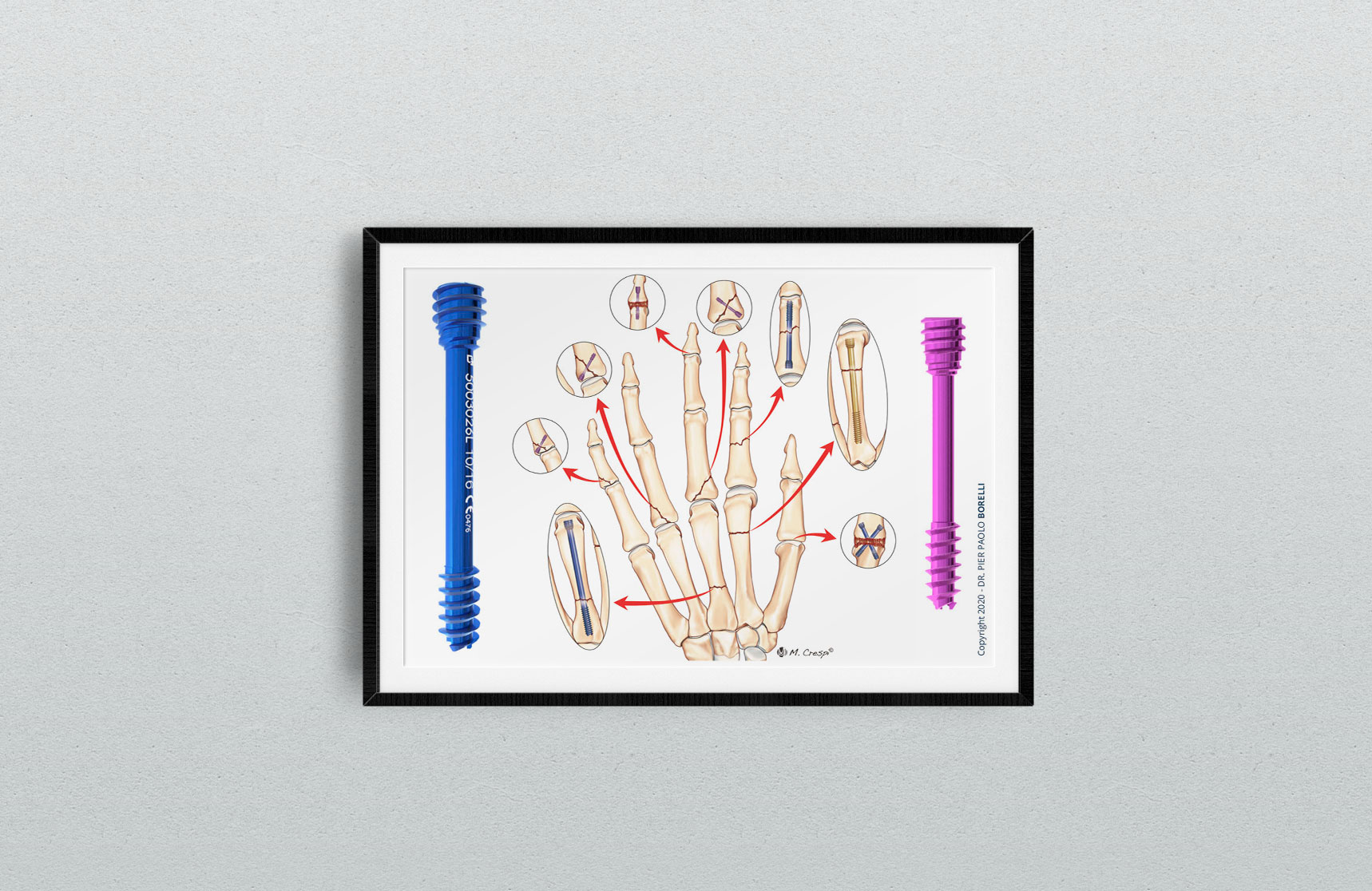 Intramedullary cannulated headless screw fixation for ...