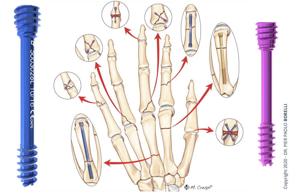 8. Biomechanical Comparison of Brooker-Wills Interlocking Intramedullary Nail Design with Plate Fixation in Distal Femur Fractures - wide 2